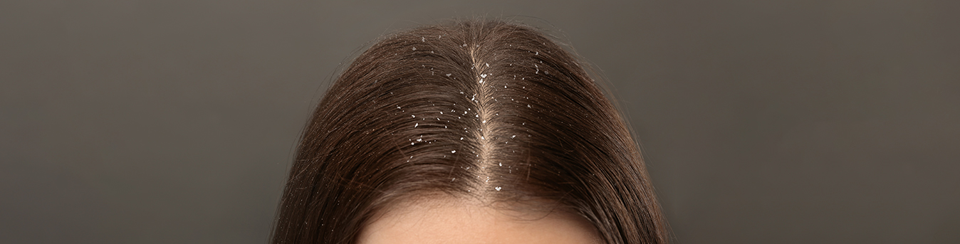 Snowflakes or dandruff flakes: Make your scalp healthier this winter